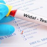 آزمایش ویدال چیست؟